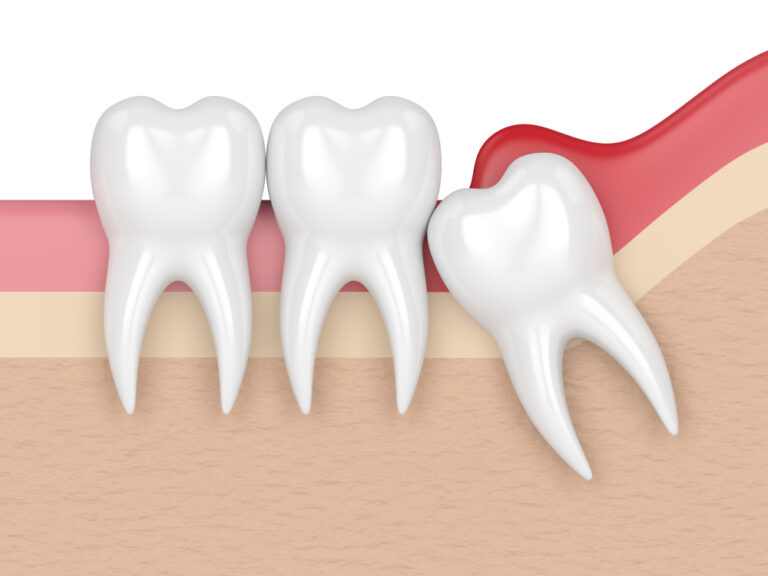 Pericoronitis Causes, Symptoms, and Treatment Options - Prosper & Smile ...